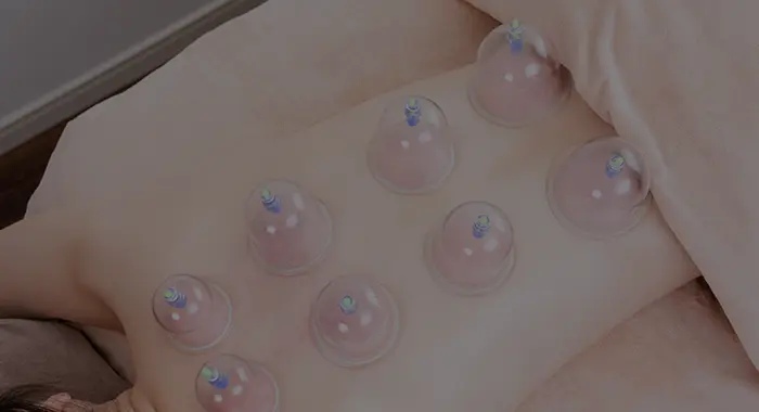 カッピング